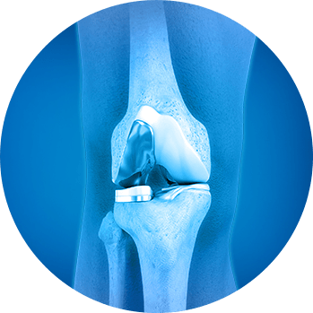 about Partial Knee Joint Replacement