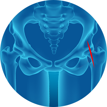 about Anterior Hip Replacement